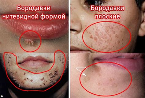 Влияние вируса на возникновение бородавок на лице