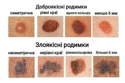 Влияние времени на появление родинок