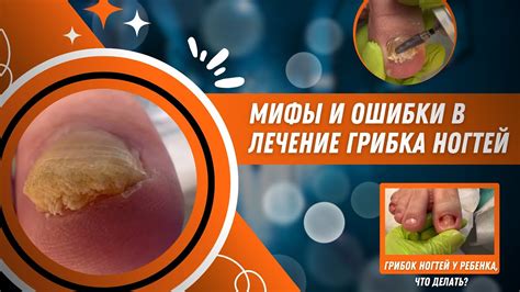 Влияние йода на грибок ногтей: мифы и реальность