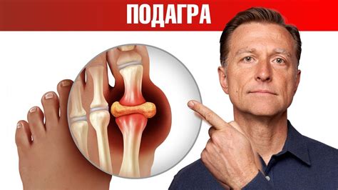 Влияние курятиной на подагру