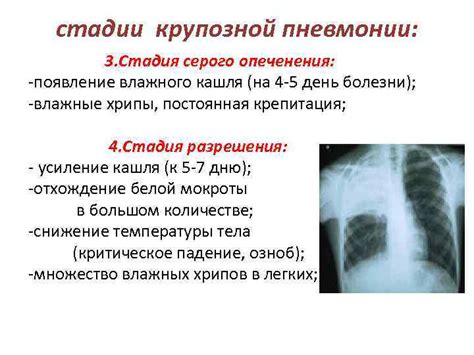 Влияние пневмонии на появление хрипов