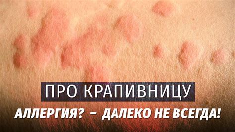 Влияние сливочного масла на крапивницу