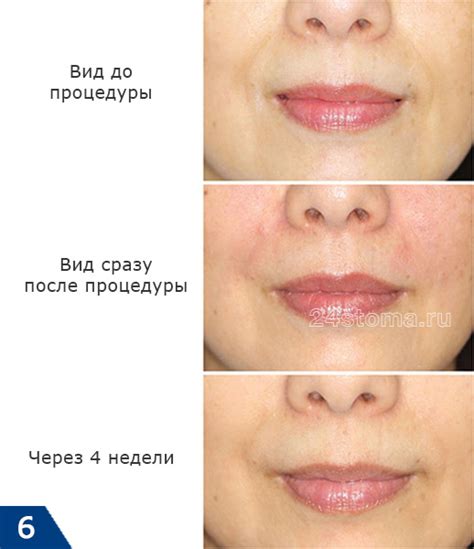 Влияние филлера на носогубные складки