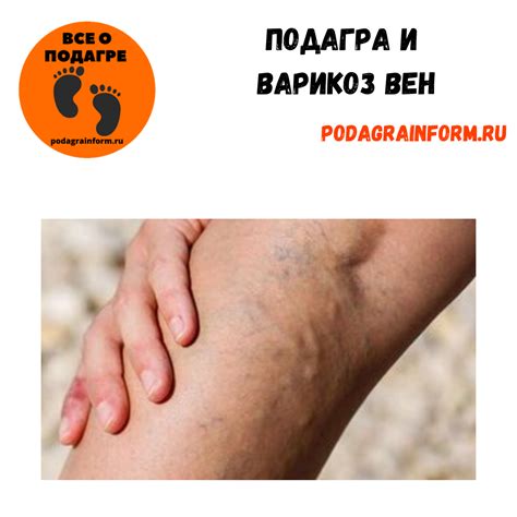 Влияние шаурмы на развитие подагры