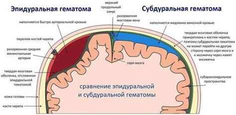 Внутренний гематом