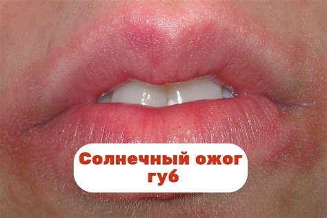 Воздействие аллергенов на кожу губ