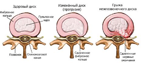 Возможность использования магнитотерапии как дополнительного метода лечения грыжи позвоночника