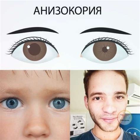Возможные причины анизокории