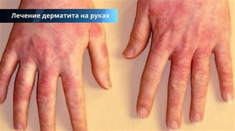 Возможные причины появления рожи на руках