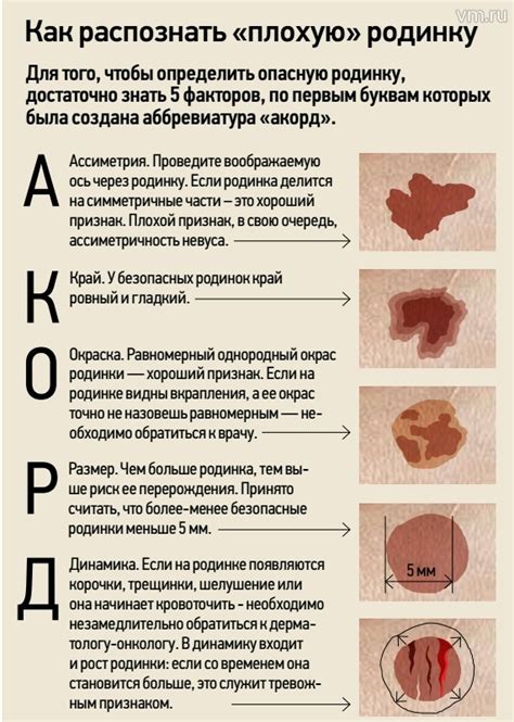Возрастные изменения и появление новых родинок