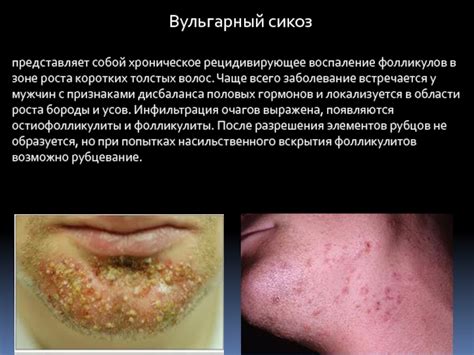 Воспаление фолликулов