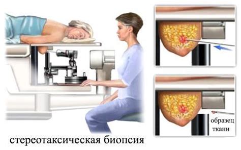 Восстановление после биопсии груди и интимная жизнь