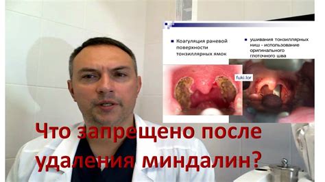 Восстановление после удаления миндалин
