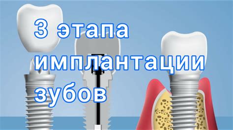 Выбор оптимального времени для имплантации