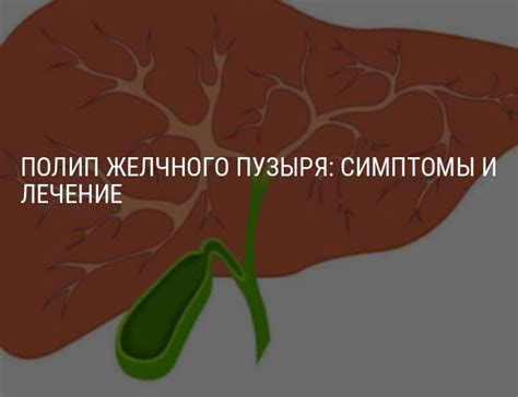 Главные симптомы полипа желчного пузыря, на которые нужно обратить внимание