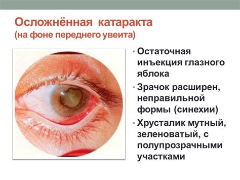 Глазные заболевания