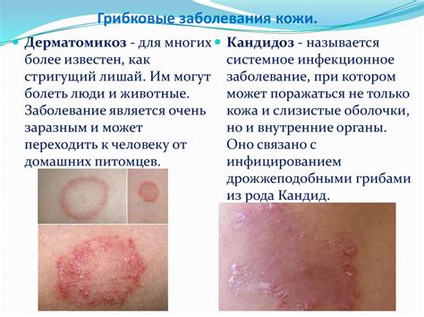 Грибковые инфекции и кожные заболевания