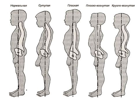 Диагностика и лечение сутулости