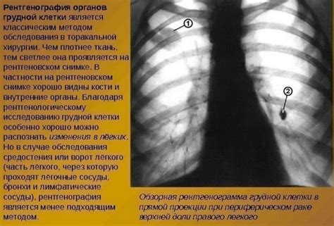 Диагностика и лечение хрипов при воспалении легких