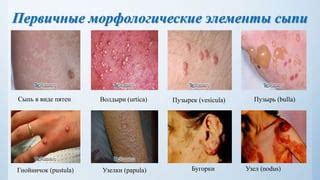 Диагностика и определение вида сыпи