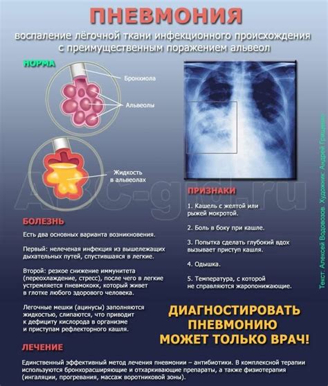 Диагностика пневмонии: как определить заболевание