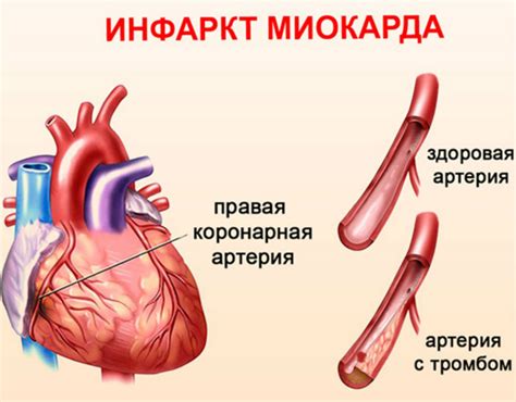 Длительность слабости после гипертонического криза