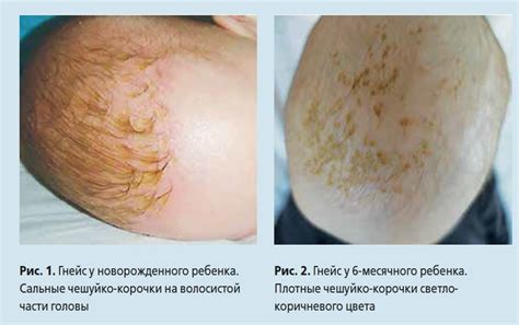 Домашние средства для лечения корочки на голове