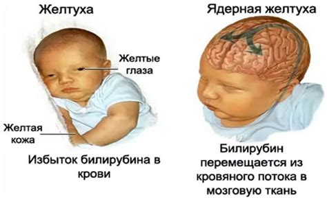 Желтушка у новорожденных: причины, симптомы, лечение