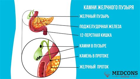 Желчекаменная болезнь: причины и симптомы