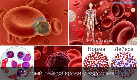 Заболевания крови