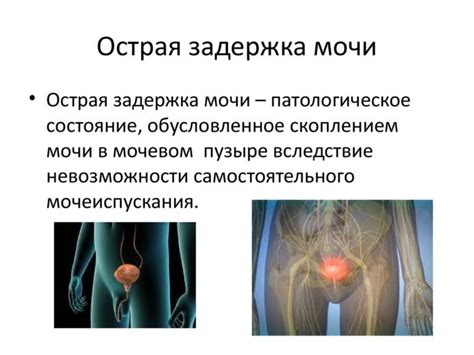 Задержка мочи в мочевом пузыре