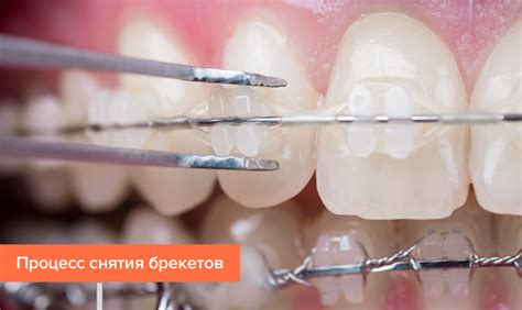 Здоровье зубов после снятия брекетов