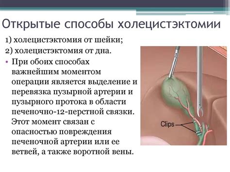 Индикации для проведения холецистэктомии от дна