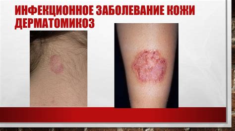 Инфекционные заболевания и воспаление кожи