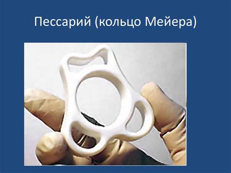 Использование пессария для лечения и поддержки беременности
