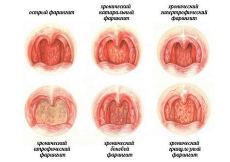 Какие заболевания горла исключают купание: медицинская точка зрения
