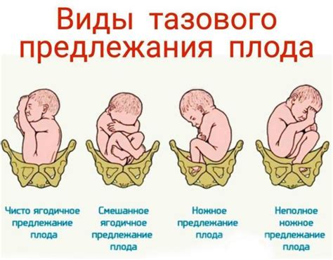 Каковы основные показания для кесарева сечения при ягодичном предлежании