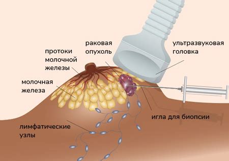 Как влияет биопсия груди на сексуальную активность