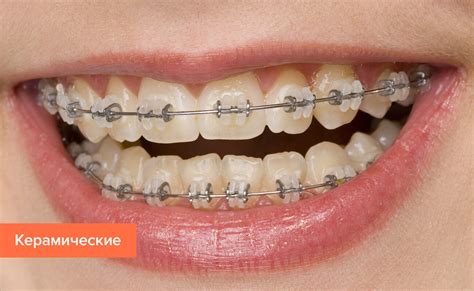 Как выбрать подходящие брекеты для коррекции зубов
