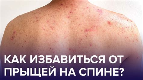 Как долго продержатся прыщи, когда вы перестали принимать ок