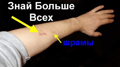 Как избавиться от шрамов от порезов