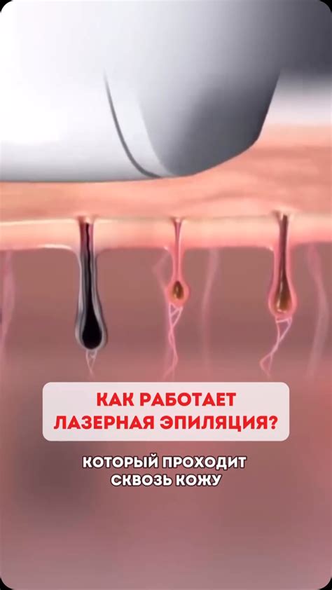 Как лазер воздействует на волосы, чтобы они перестали расти