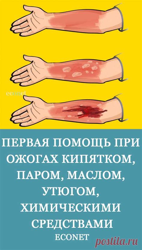 Как помочь при ожогах