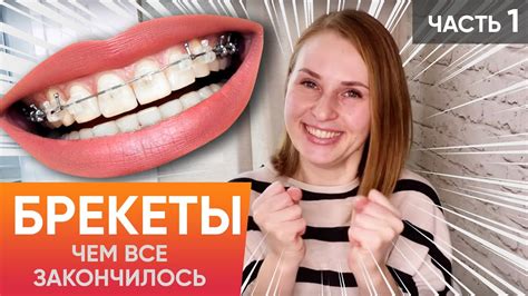 Как правильно есть хлеб, если у вас есть брекеты