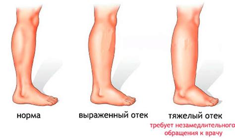 Как предотвратить отеки ног при повышенном давлении