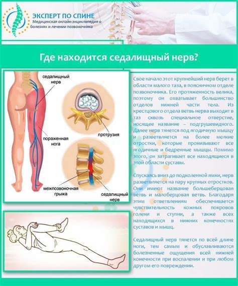 Как предотвратить повреждение седалищного нерва при уколах