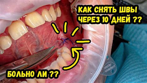 Как проходит процесс снятия швов с десны