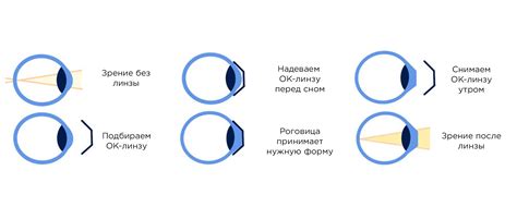 Как работают ночные линзы