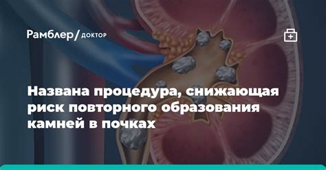 Как снизить риск повторного образования кисты после вакуумной аспирации через спорт