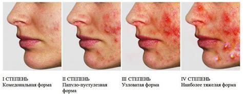 Как ускорить исчезновение прыщей при противозачаточных